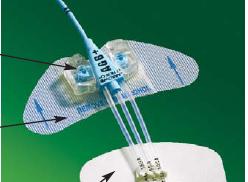 statlock-reg-central-venous-catheter-stabilization-device